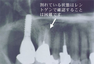 抜歯即時６