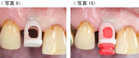 抜歯即時9,10