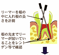 抜随１