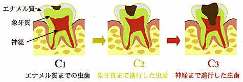 虫歯のレベル