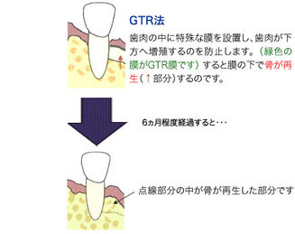 gtr2