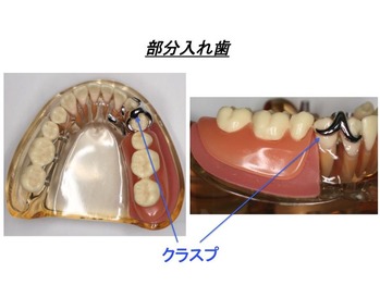 部分入れ歯