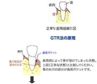 gtr1