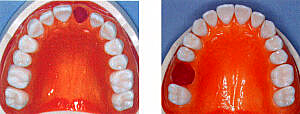 前歯もしくは臼歯部1歯欠損の場合