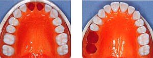 前歯もしくは臼歯部2歯欠損の場合
