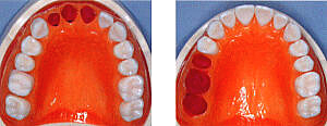前歯もしくは臼歯部3歯欠損の場合