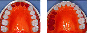前歯もしくは臼歯部4歯欠損の場合