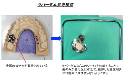 ラバーダム