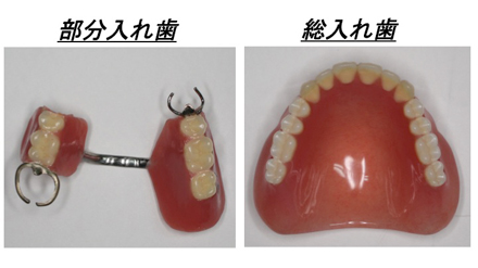 入れ歯と金属アレルギー