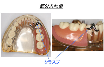 入れ歯と金属アレルギー