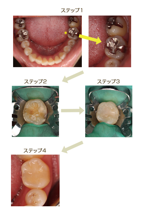 CR治療方法