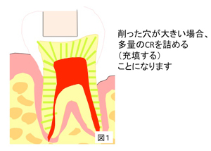 削った穴が大きい場合、多量のCRを詰めることになります