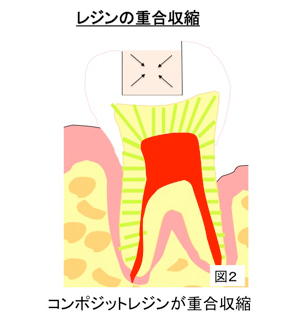 コンポジットレジンが重合収縮