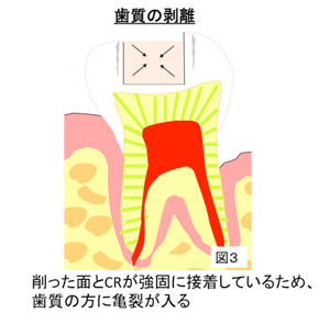 削った面とCRが強固に接着しているため、歯質の方に亀裂が入る