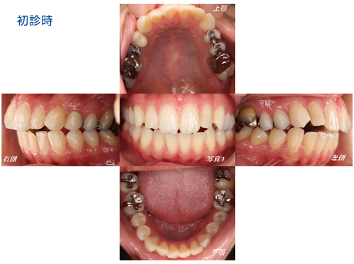 初診時の口腔写真