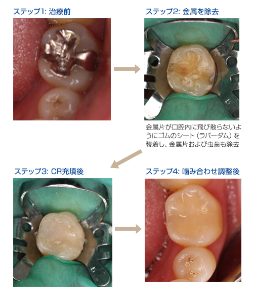 下顎左側のステップ