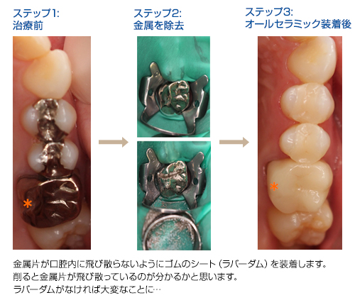 下顎左側のステップ