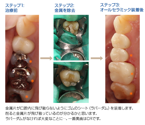 上顎右側のステップ