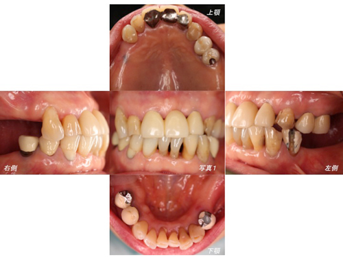初診時の口腔写真