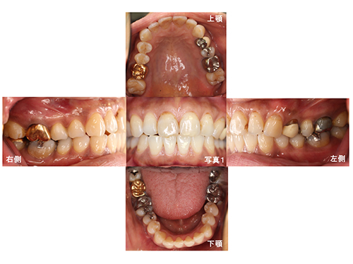 初診時の口腔写真