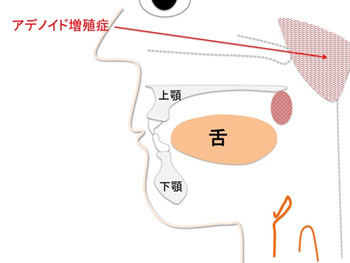 咽頭扁桃（アデノイド）増殖症