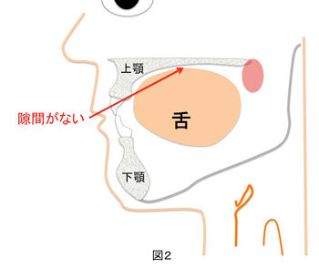 図２：上顎との隙間が少なくなり、嫌気性菌が繁殖しやすい状態