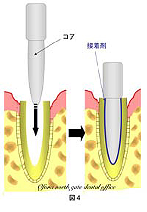 『コア』を歯質に接着する方法