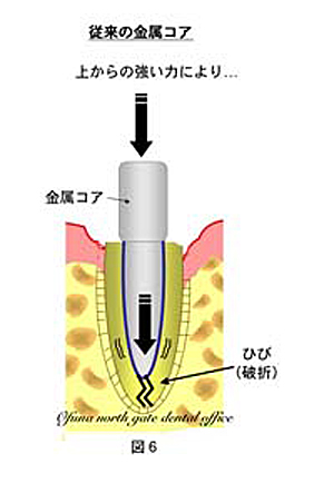 従来の『金属製のコア』