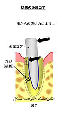 神経のない歯は全て割れるのか？