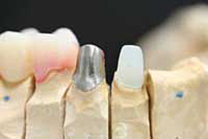 歯根破折しないための治療法：『ファイバーコア』