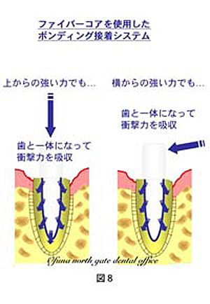 歯根破折しないための治療法：『ボンディング接着システム』