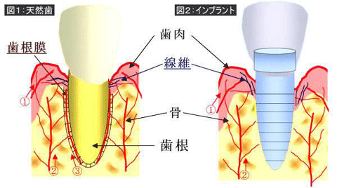 インプラントと天然歯の違い