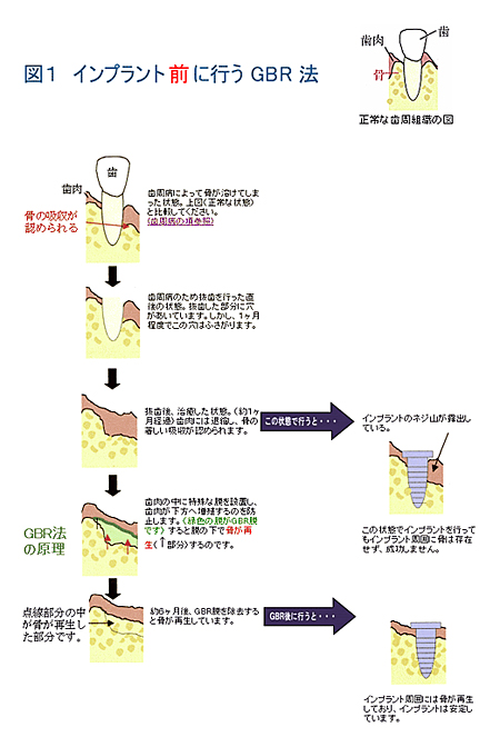 図1：インプラント前に行うGBR法