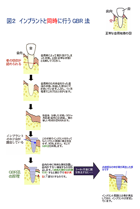 図2：インプラントと同時に行うGBR法