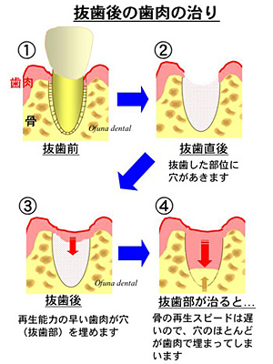 骨はなぜ再生（増骨）できるのか？（骨再生のメカニズム）