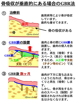 骨再生の限界