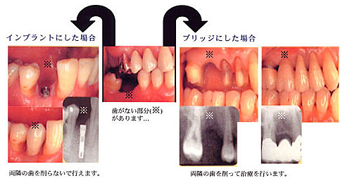 インプラントとブリッジの比較