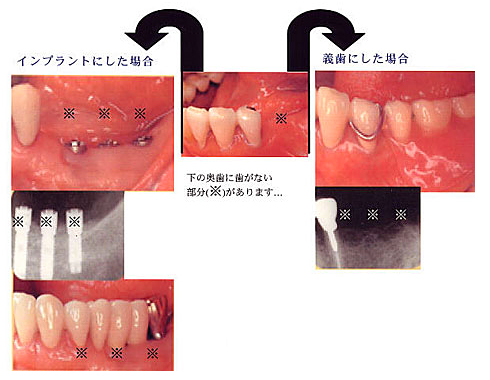 インプラントと義歯の比較