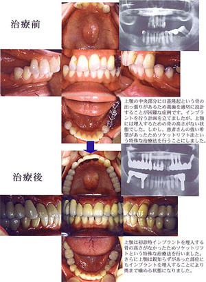 歯の欠損が数本ある方の場合