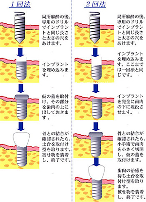 優しい治療 その3：1回法インプラント