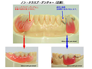 ノン・クラスプ・デンチャー症例