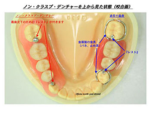 レスト付きノン・クラスプ・デンチャー