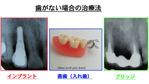 歯がない場合の治療法