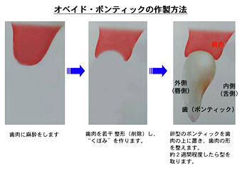 オベイド・ポンティックの作製方法