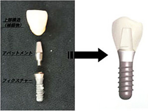 一般的なインプラント構造