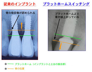 従来のインプラントのおける骨吸収像