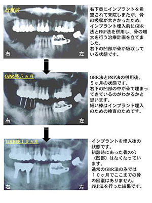 PRP症例（GBR法との併用）