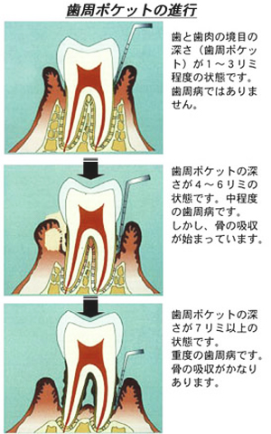 歯周ポケットの進行