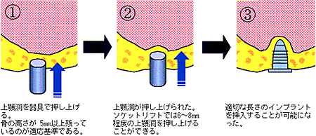 インプラントを行うことが可能