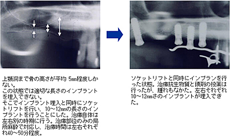 ソケットリフト法